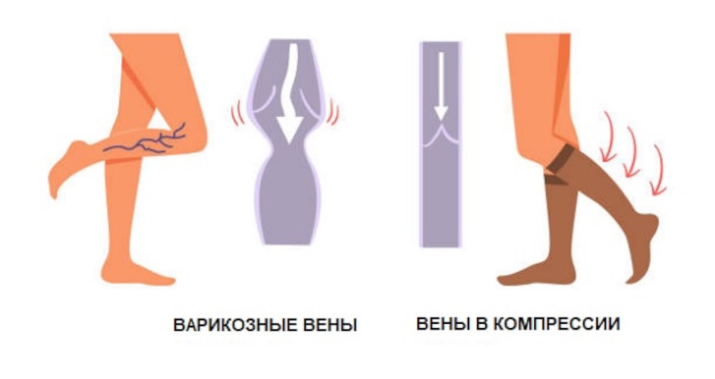 4 Современные методы лечения венозной недостаточности