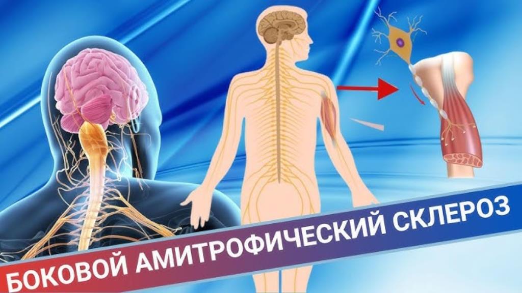 Боковой амиотрофический склероз (БАС): что важно знать о заболевании