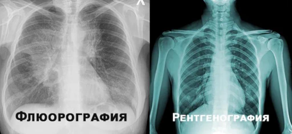 Что информативнее: рентген грудной клетки или флюорография
